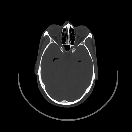 Arrow injury to the brain (Radiopaedia 72101-82607 Axial bone window 64).jpg