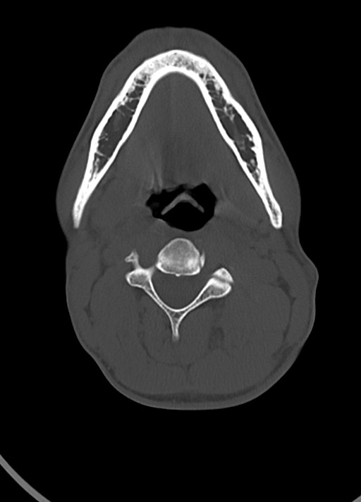 Arrow injury to the head (Radiopaedia 75266-86388 Axial bone window 18).jpg
