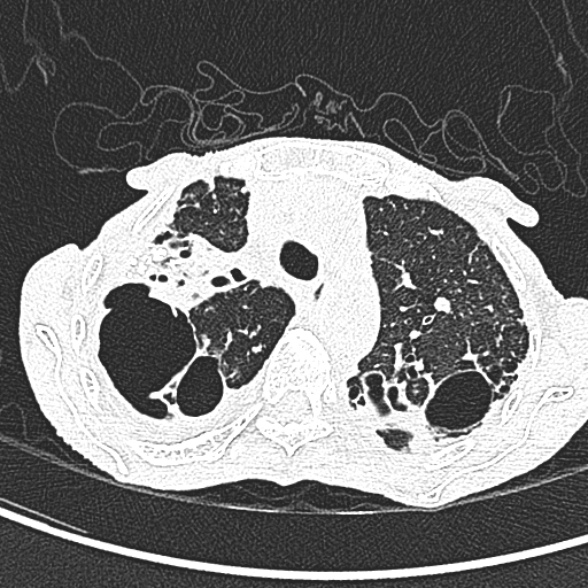 Aspergilloma- with Monod sign (Radiopaedia 44737-48532 Axial lung window 78).jpg