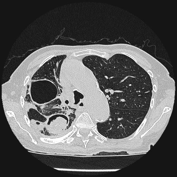 Aspergilloma (Radiopaedia 24458-24763 Axial lung window 21).jpg