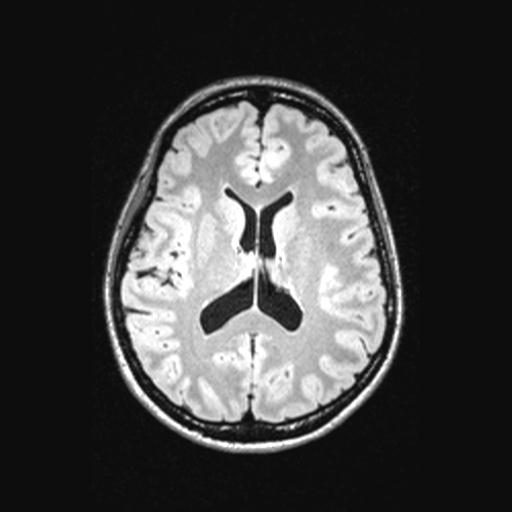 Atretic encephalocoele with inferior vermis hypoplasia (Radiopaedia 30443-31108 Axial 93).jpg