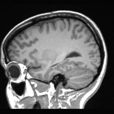 Atretic encephalocoele with inferior vermis hypoplasia (Radiopaedia 30443-31108 Sagittal T1 37).jpg