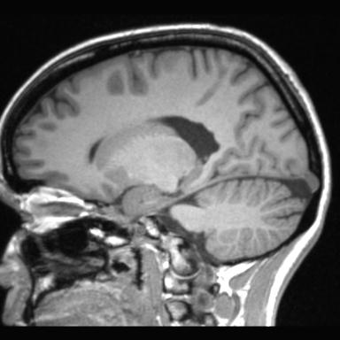 File:Atretic encephalocoele with inferior vermis hypoplasia (Radiopaedia 30443-31108 Sagittal T1 81).jpg