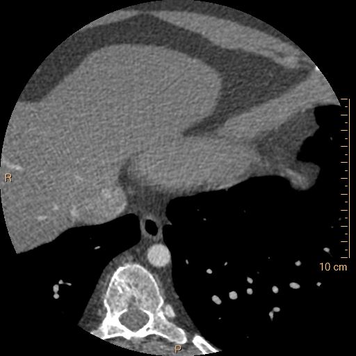 Atrial septal defect (upper sinus venosus type) with partial anomalous pulmonary venous return into superior vena cava (Radiopaedia 73228-83961 A 249).jpg