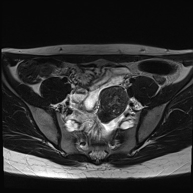File:Atypical deep infiltrating endometriosis (Radiopaedia 44470-48125 Axial T2 6).jpg