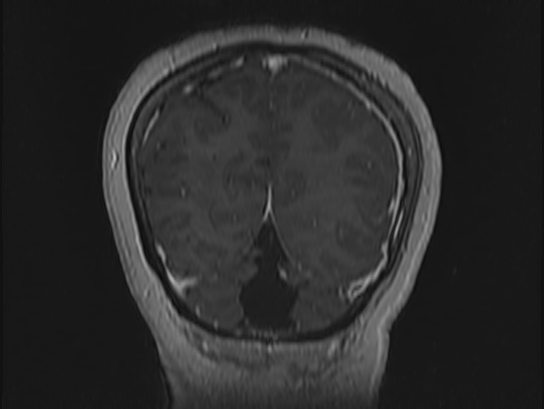 Atypical meningioma (Radiopaedia 62985-71406 Coronal T1 C+ 108).jpg