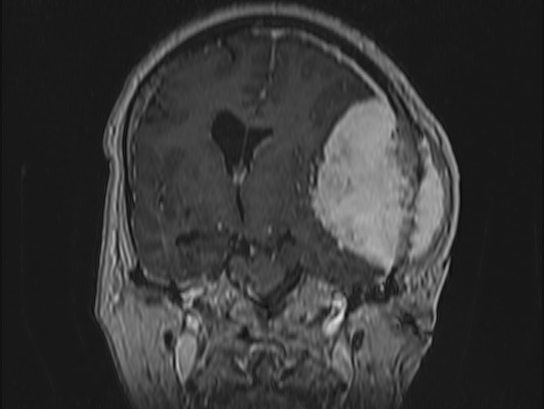 Atypical meningioma (Radiopaedia 62985-71406 Coronal T1 C+ 56).jpg