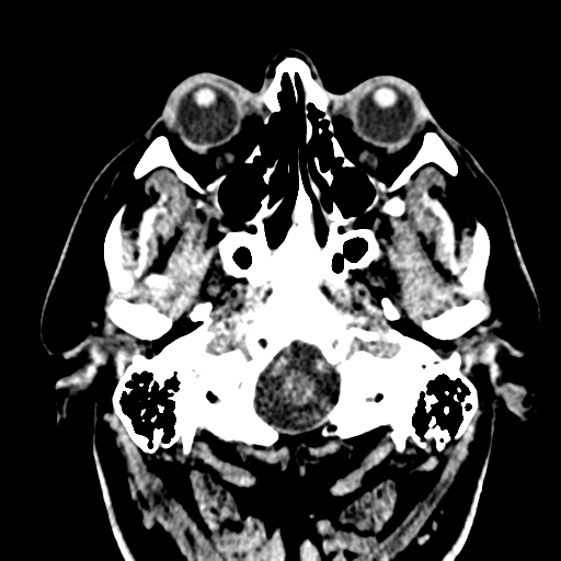 File:Atypical meningioma (WHO grade II) with brain invasion (Radiopaedia 57767-64728 Axial non-contrast 1).png