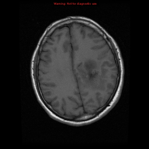 File:Atypical meningioma - grade II (Radiopaedia 13303-13305 Axial T1 15).jpg