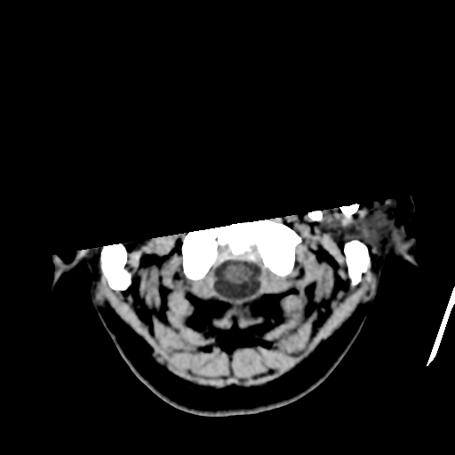 Atypical meningioma with skull invasion (Radiopaedia 34357-35649 Axial non-contrast 4).png