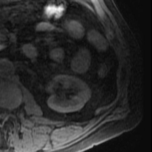 File:Atypical renal cyst on MRI (Radiopaedia 17349-17046 Axial T1 fat sat 21).jpg