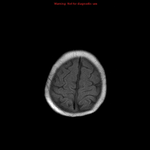 File:Atypical teratoid rhabdoid tumor (Radiopaedia 10712-11183 Axial T1 2).jpg