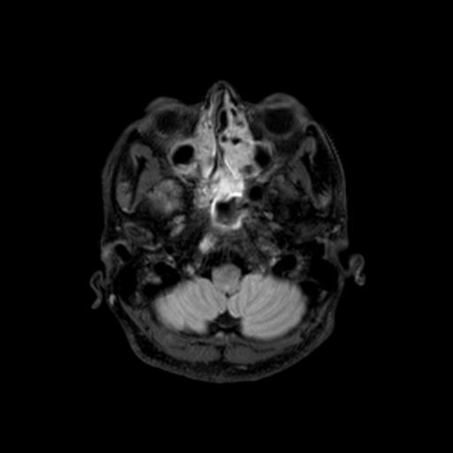 File:Autoimmune limbic encephalitis (Radiopaedia 30363-31005 Axial FLAIR 11).jpg