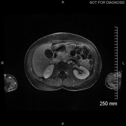 Autoimmune pancreatitis (Radiopaedia 88443-105101 A 72).jpg