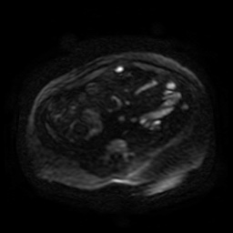 File:Autosomal dominant polycystic kidney disease (Radiopaedia 50259-55611 Axial DWI 105).jpg