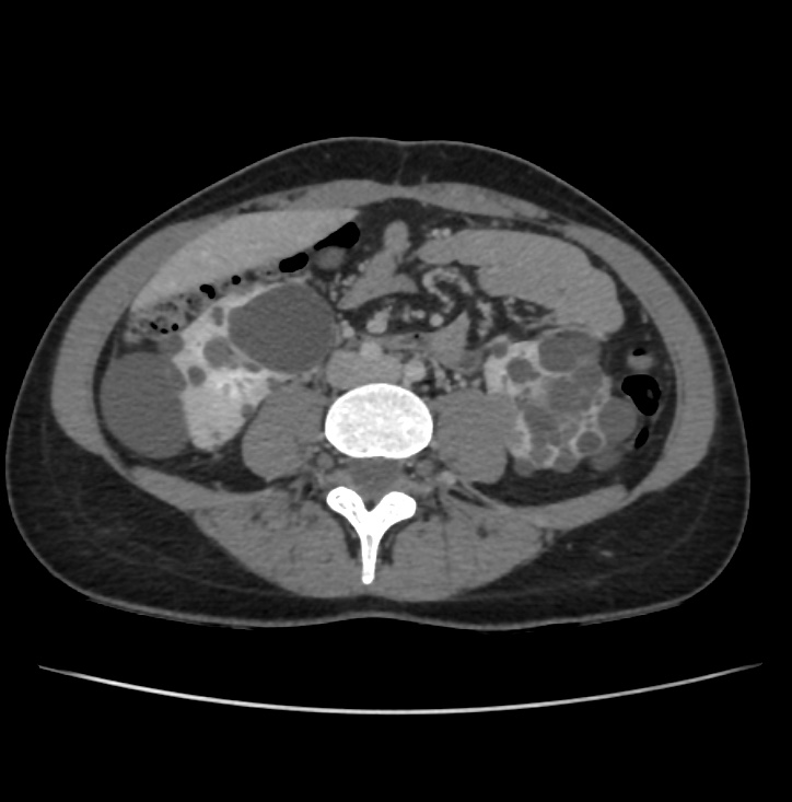Autosomal dominant polycystic kidney disease - early onset (Radiopaedia 40734-43387 A 51).jpg