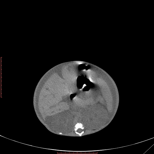 Autosomal recessive polycystic kidney disease associated with Caroli disease (Radiopaedia 61932-69984 B 178).jpg