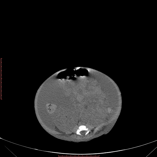 Autosomal recessive polycystic kidney disease associated with Caroli disease (Radiopaedia 61932-69984 B 256).jpg
