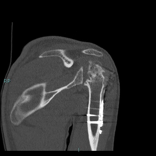 Avascular necrosis after fracture dislocations of the proximal humerus (Radiopaedia 88078-104655 Coronal bone window 65).jpg