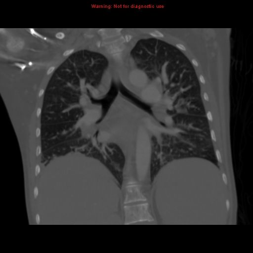 File:Avascular necrosis in sickle cell disease (Radiopaedia 17448-17152 Coronal bone window 76).jpg