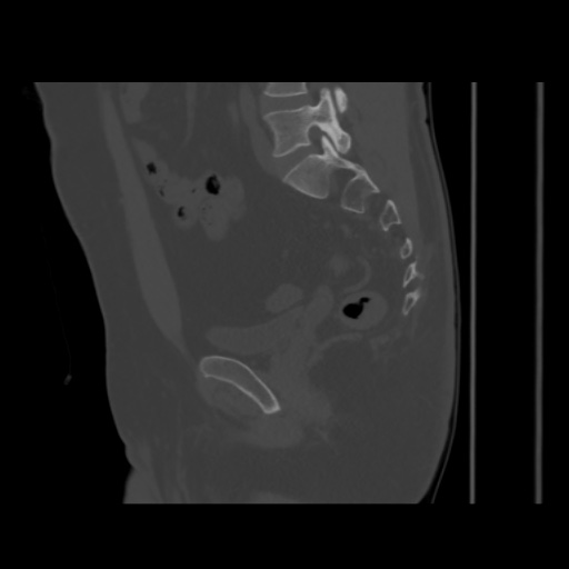 Avascular necrosis of the hip (Radiopaedia 61503-69467 B 34).jpg