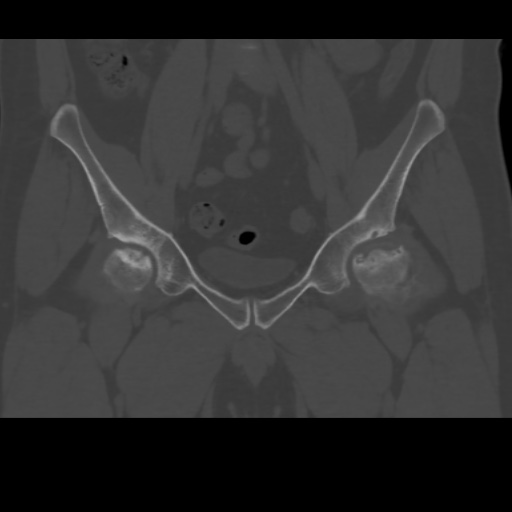 File:Avascular necrosis of the hip (Radiopaedia 61503-69467 Coronal bone window 10).jpg