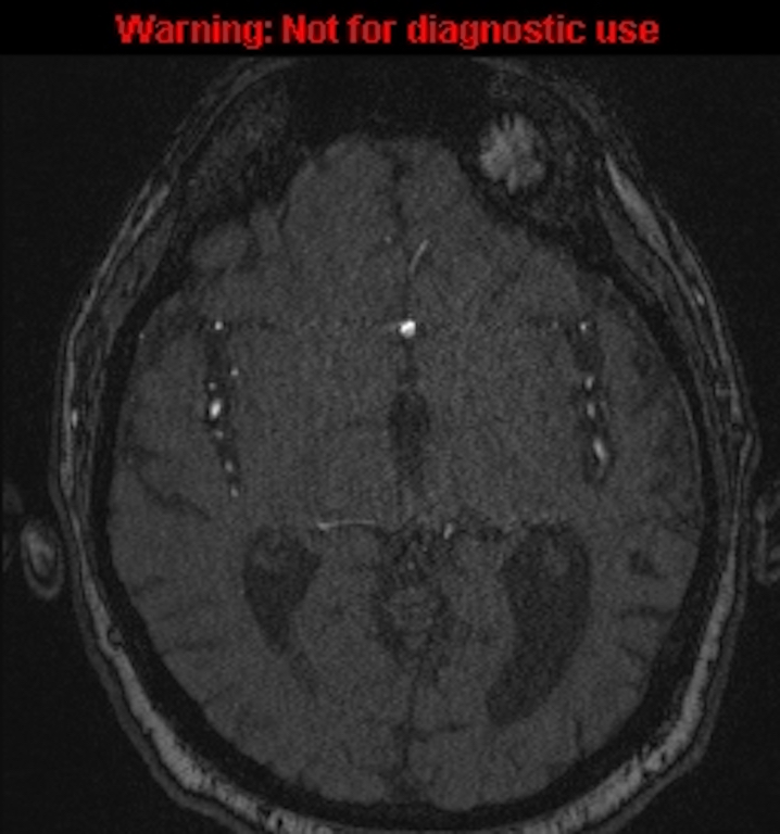 Azygos anterior cerebral artery (Radiopaedia 59325-66677 Axial MRA 80).jpg