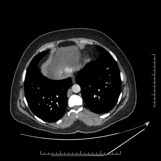 File:Azygos continuation of the IVC (Radiopaedia 40416-42965 A 4).jpg