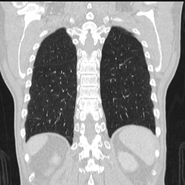 Azygos lobe (Radiopaedia 38259-40275 Coronal lung window 63).jpg