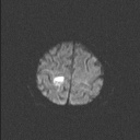 Balo concentric sclerosis (Radiopaedia 50458-55940 Axial DWI 50).jpg