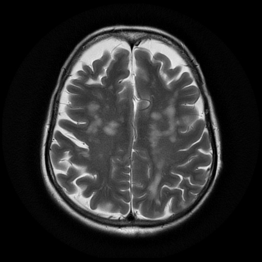 File:Balo concentric sclerosis (Radiopaedia 53875-59982 Axial T2 18).jpg