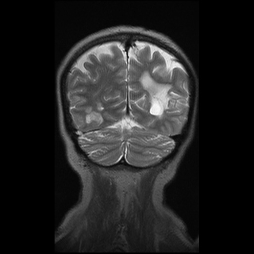 Balo concentric sclerosis (Radiopaedia 53875-59982 Coronal T2 14).jpg