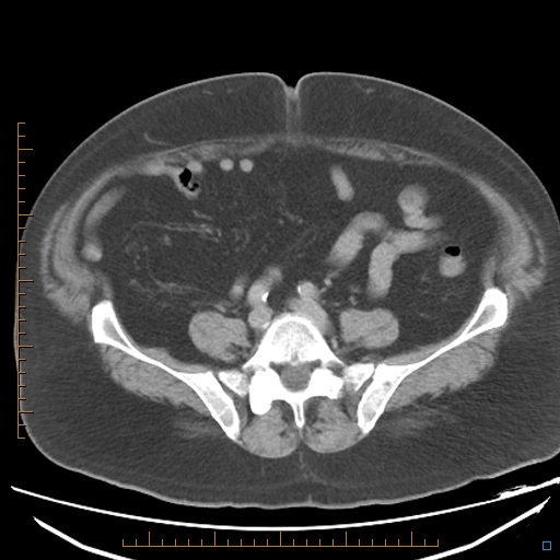 File:Bariatric balloon causing gastric outlet obstruction (Radiopaedia 54449-60672 A 29).jpg