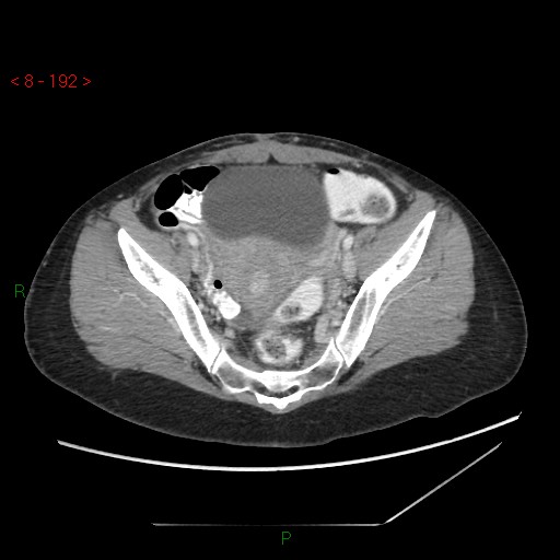 Bartholin gland cyst (Radiopaedia 54904-61181 A 48).jpg