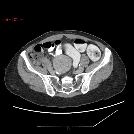 File:Bartholin gland cyst (Radiopaedia 54904-61181 Axial C+ delayed 26).jpg