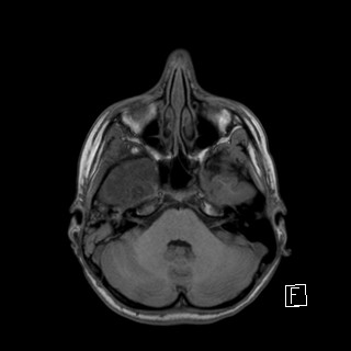 Base of skull rhabdomyosarcoma (Radiopaedia 32196-33142 Axial T1 12).jpg