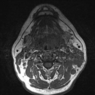 File:Base of tongue squamous cell carcinoma (Radiopaedia 31174-31884 Axial T1 15).jpg