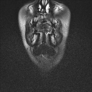 File:Base of tongue squamous cell carcinoma (Radiopaedia 31174-31884 Coronal T2 fat sat 24).jpg