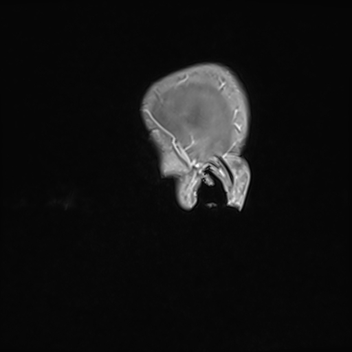 File:Basilar artery perforator aneurysm (Radiopaedia 82455-97733 G 7).jpg