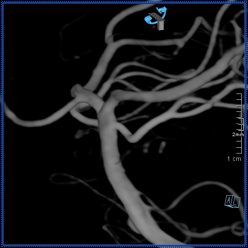 Basilar artery perforator aneurysm (Radiopaedia 82455-99524 3D Left VA 30).jpg
