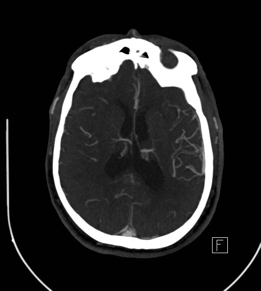 Basilar artery thrombosis (Radiopaedia 26986-27163 A 53).jpg