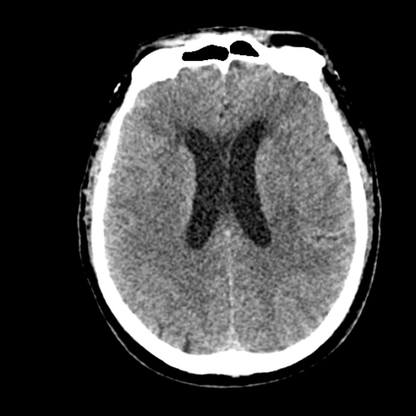 Basilar artery thrombosis (Radiopaedia 53351-59352 Axial non-contrast 74).jpg