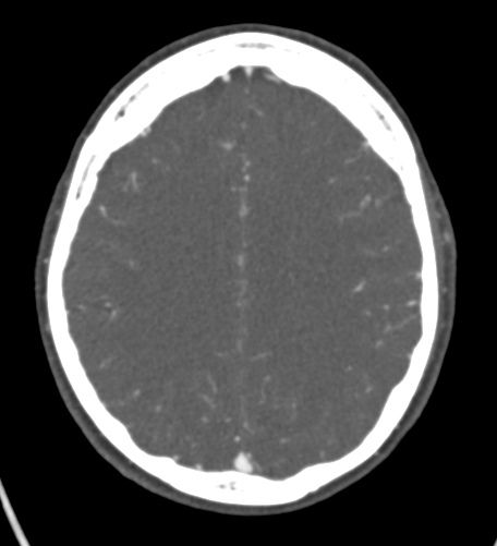 File:Basilar tip aneurysm with coiling (Radiopaedia 53912-60086 A 102).jpg