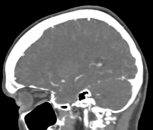 File:Basilar tip aneurysm with coiling (Radiopaedia 53912-60086 C 39).jpg