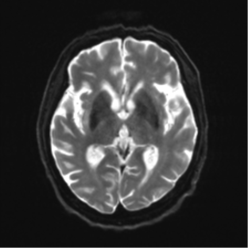 Behavioral variant frontotemporal dementia and late onset schizophrenia (Radiopaedia 52197-58083 Axial DTI Trace W 13).png
