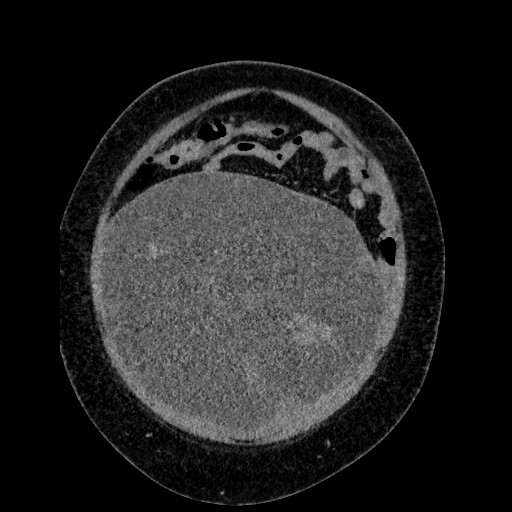 Benign leiomyoma with hydropic features (Radiopaedia 89250-106130 B 27).jpg