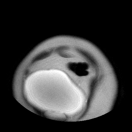 File:Benign seromucinous cystadenoma of the ovary (Radiopaedia 71065-81300 Coronal T2 5).jpg