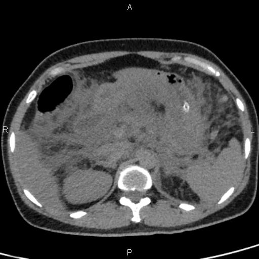 Bilateral adrenal gland hyperenhancement in pancreatitis (Radiopaedia 86642-102753 Axial non-contrast 34).jpg