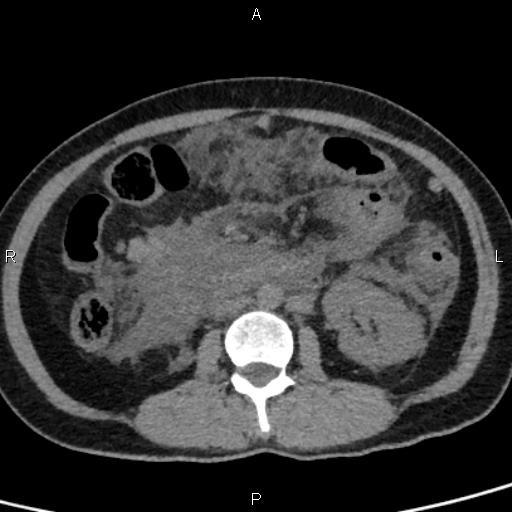 Bilateral adrenal gland hyperenhancement in pancreatitis (Radiopaedia 86642-102753 Axial non-contrast 56).jpg