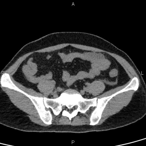 Bilateral adrenal gland hyperenhancement in pancreatitis (Radiopaedia 86642-102753 Axial non-contrast 84).jpg